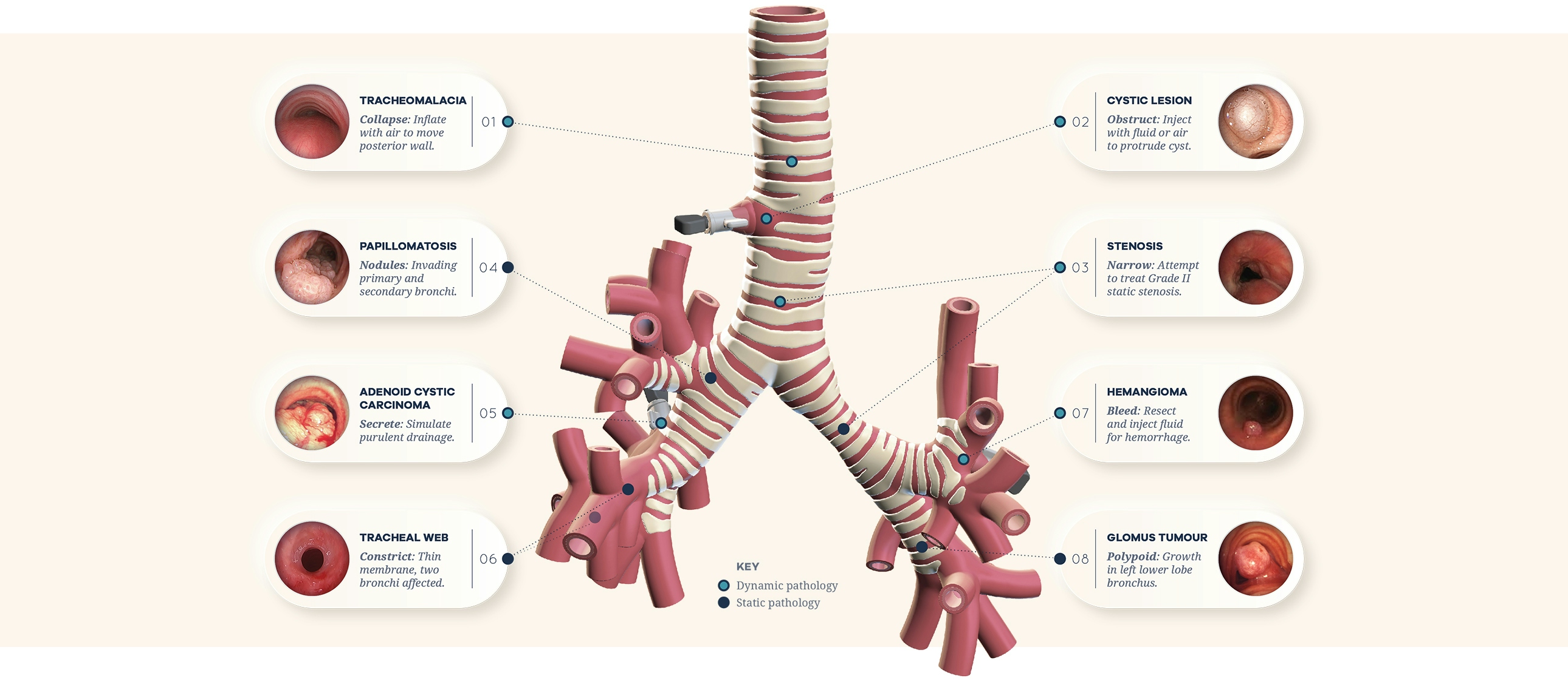 Diagram showing location and type of pathology inside trachea model.
