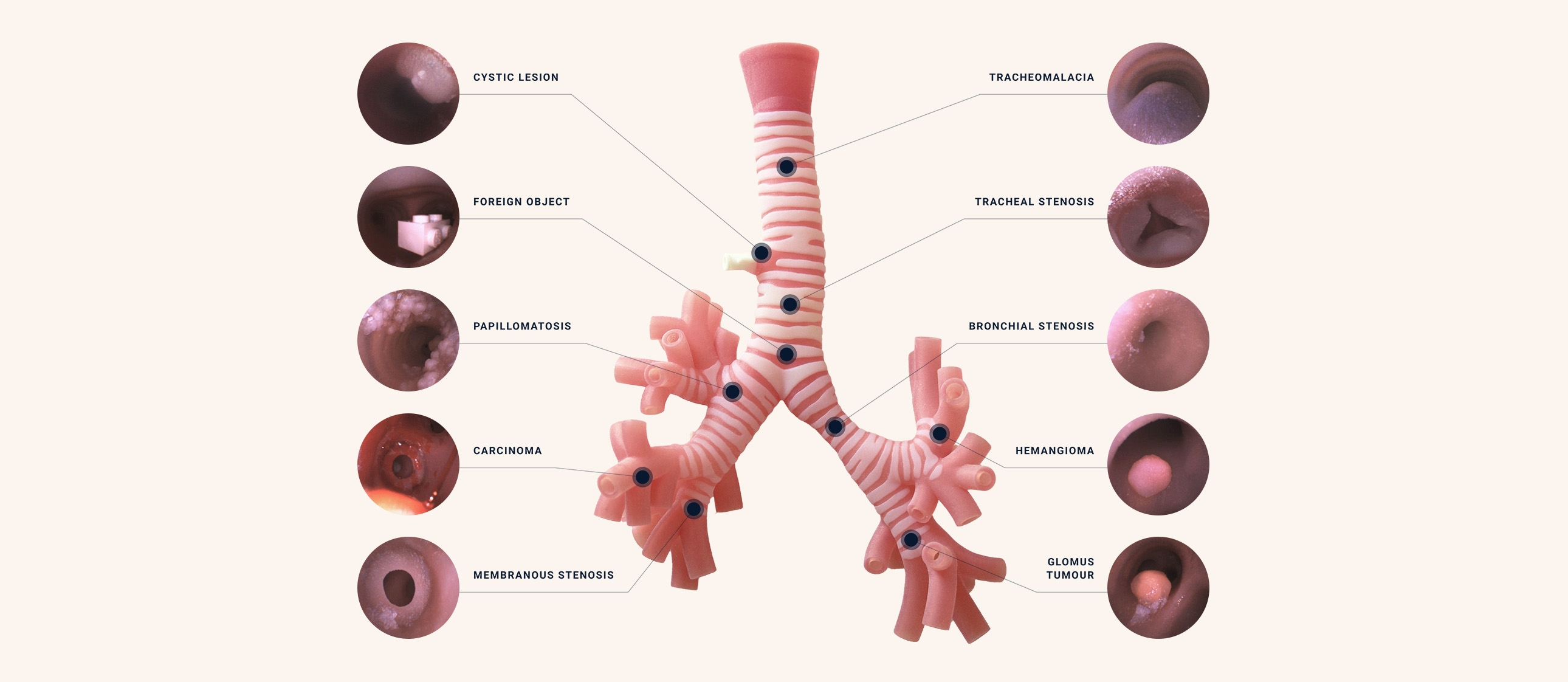 Diagram showing location and type of pathology inside trachea model.