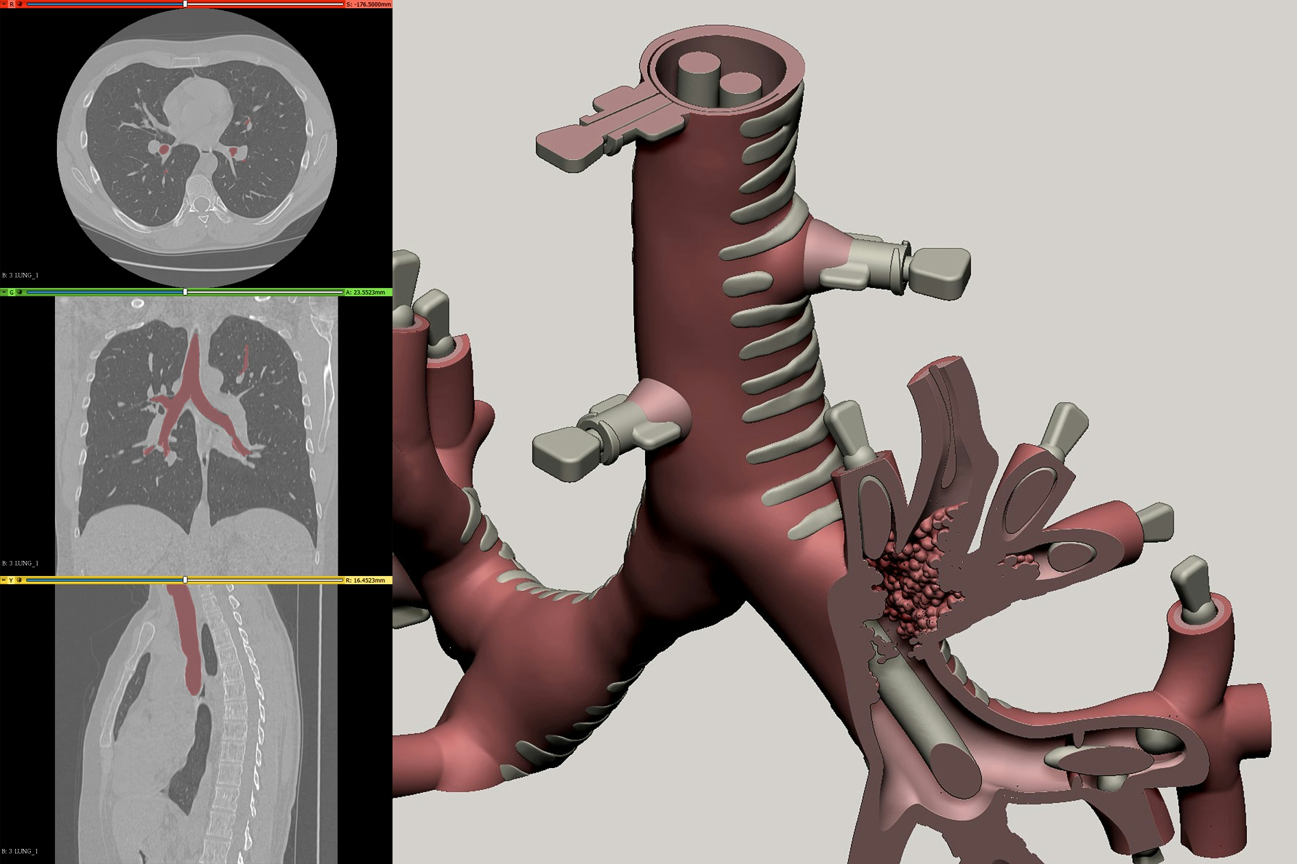 Patient scan data with trachea segmented. Section view of trachea 3D model revealing internal pathology and stents.
