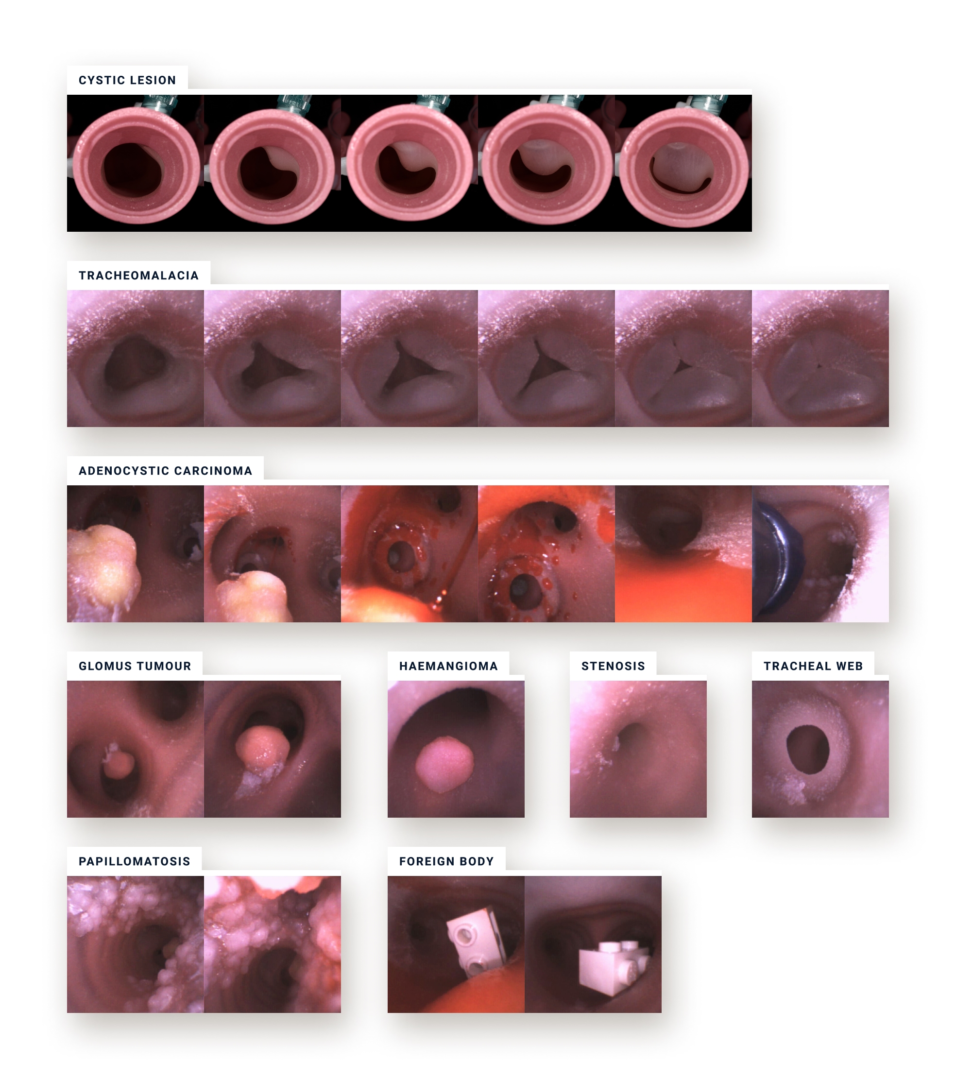 Simulated bronchoscopy capturing movement of pathology.