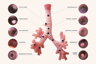 Diagram showing location and type of pathology inside trachea model.