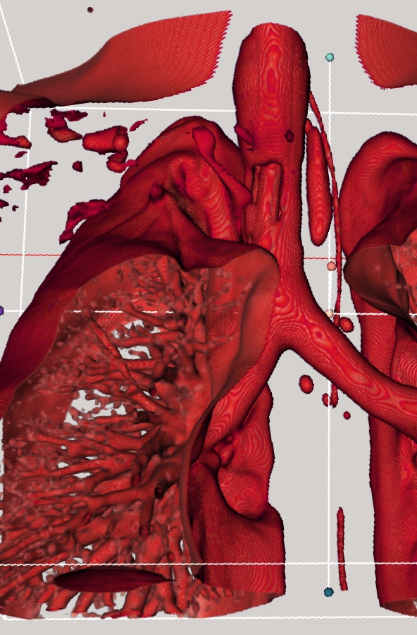 Cross section of patient scan data showing inside of lungs.